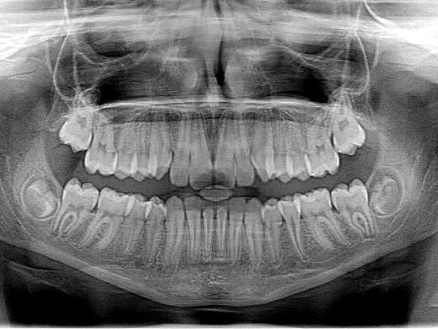 X-Ray