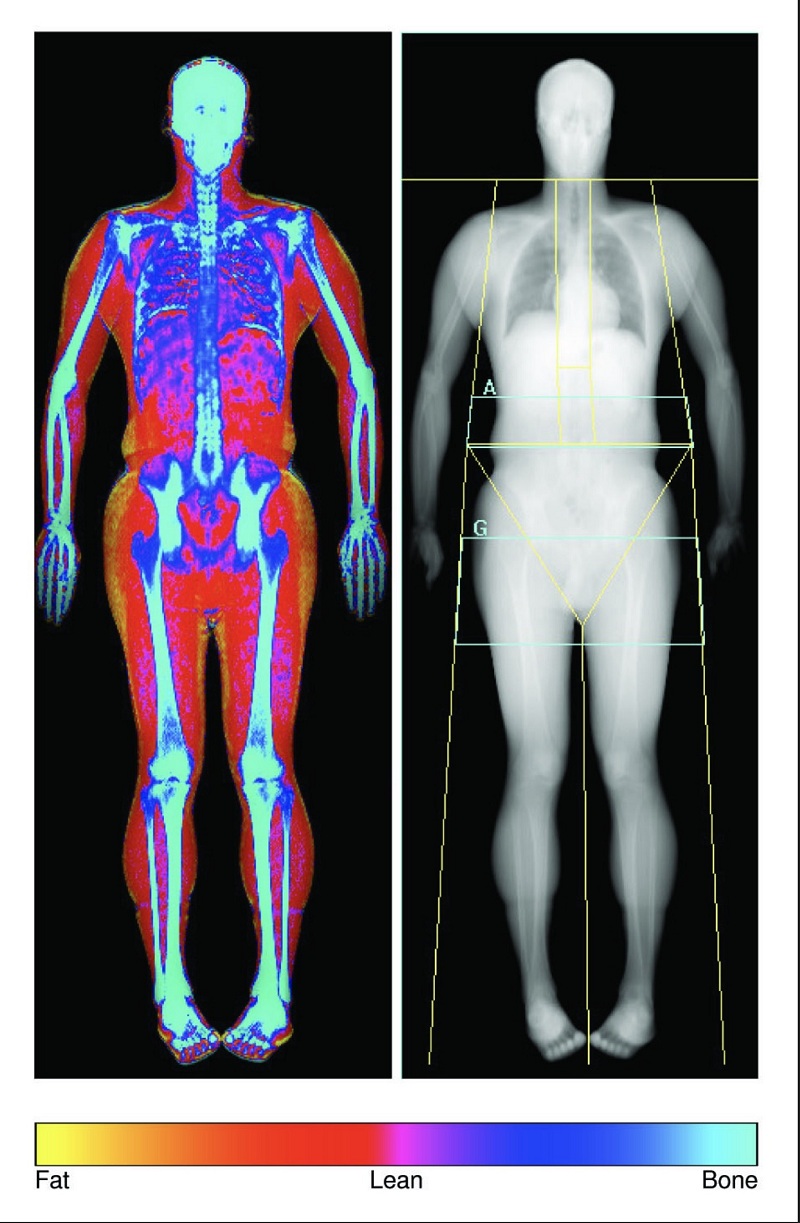 Internal Purchase DEXA