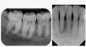 INTRAORAL PERIAPICAL