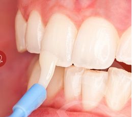 FLUORIDE VARNISH