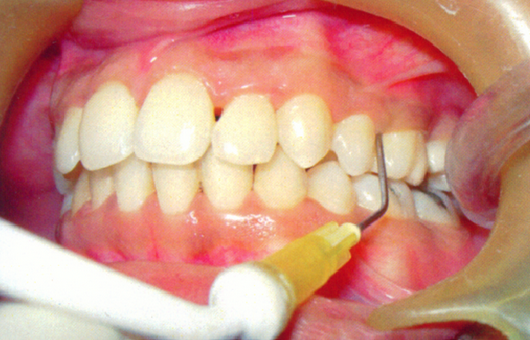 GINGIVAL IRRIGATION - Per Quadrant