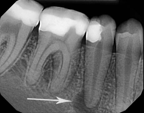 Image result for teeth x rays abscess